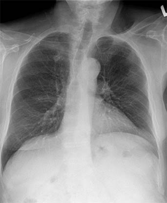 Standard Chest X-Ray